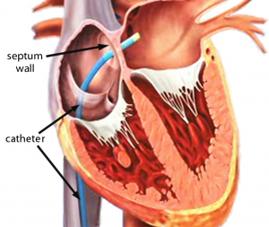 Catheter-punch-through-into-Left-AtriaC-300x253